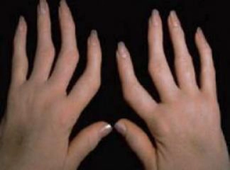 Seronegatif Artrit Belirtileri ve Tedavisi Seronegatif Artrit Belirtileri ve Tedavisi