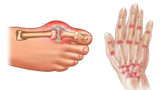 Artrit Çeşitleri Nelerdir?