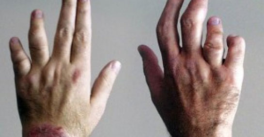 Psöriatik Artrit Belirtileri ve Tedavisi