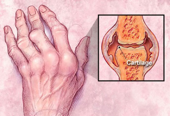 Romatoid Artrit Tan Kriterleri