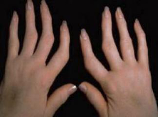 Seronegatif Artrit Belirtileri ve Tedavisi